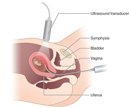 Image result for chorionic villus sampling