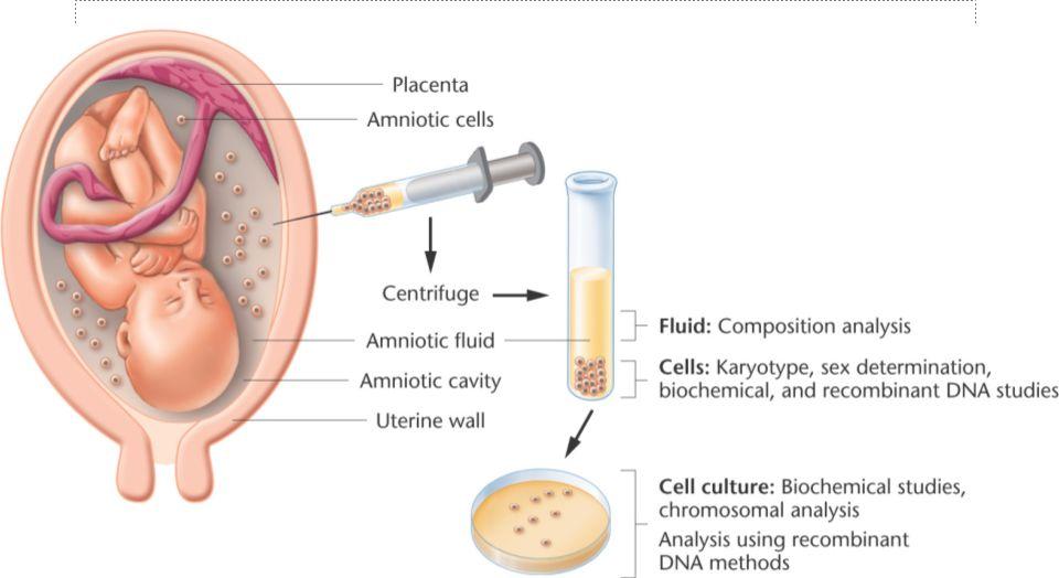 Image result for amniocentesis